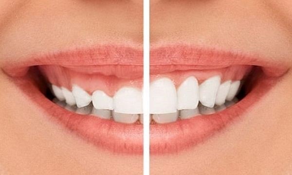 افزایش طول تاج دندان‌ها